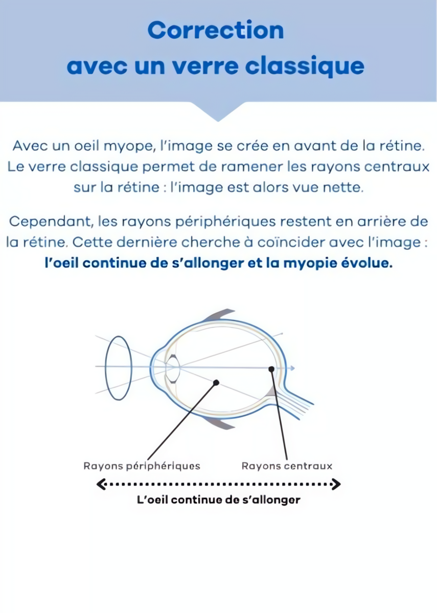 Optique Codet Opticien Avranches Correction Avec Un Verre Classique